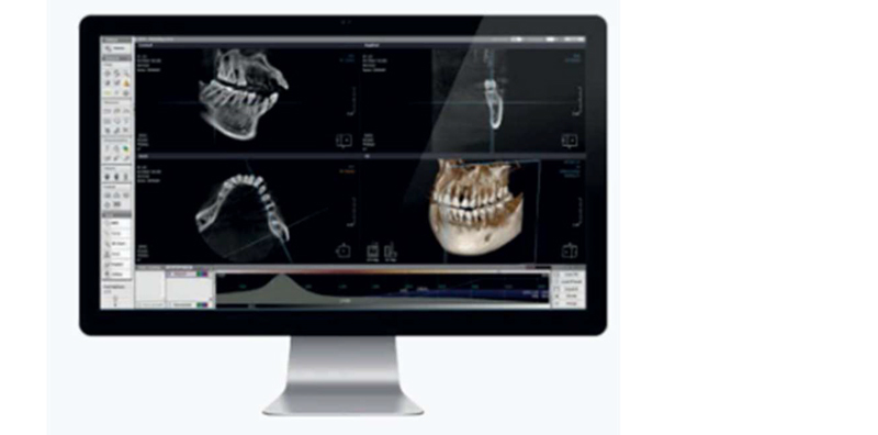 Software Xelis pentru planificare implanturi