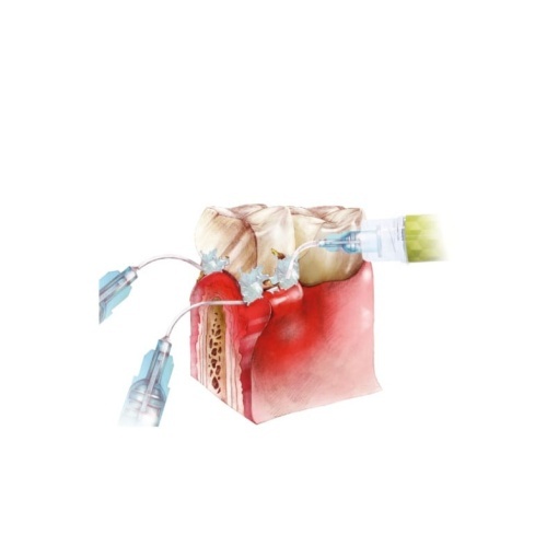Soluție pentru irigarea pungilor parodontale Arkona Perioflush, kit 10 seringi x 3ml - Img 4