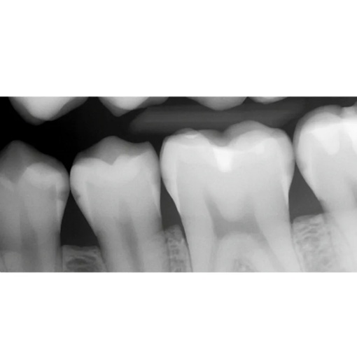 Senzor intraoral radiologic Digisens HD - Img 2
