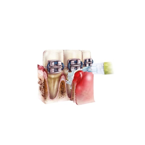 Soluție pentru irigarea pungilor parodontale Arkona Perioflush, kit 10 seringi x 3ml - Img 3