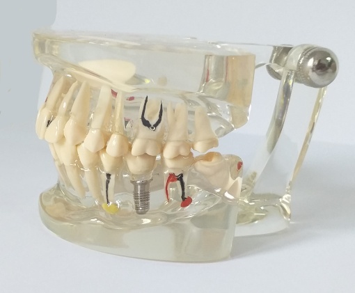Model dentar patologic C4 - Img 2