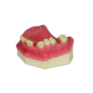 Modele pentru implant dentar rapid