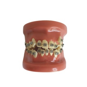 Model dentar orthodontic B1