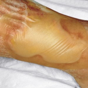 Pansament Hydrocoll - Img 5