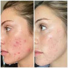 Tretinoin gel 0, 025 % Tratarea acneei (cosuri, puncte negre, puncte albe), Micsorarea porilor, Estomparea petelor pigmentare, Diminuarea ridurilor fine, 20 g - Img 2