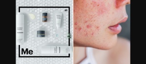 Mesoestetic Blemiderm Pack – Acne-Prone Skin Routine Set - Img 3