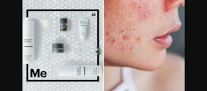 Mesoestetic Blemiderm Pack – Acne-Prone Skin Routine Set - Img 3